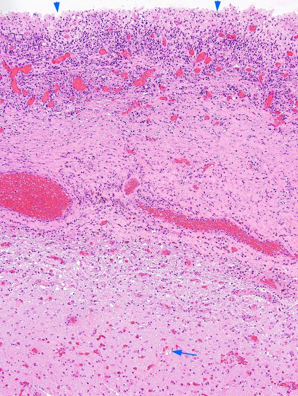 6B2 Abscess, acute & chronic (Case 6) H&E 7 copy