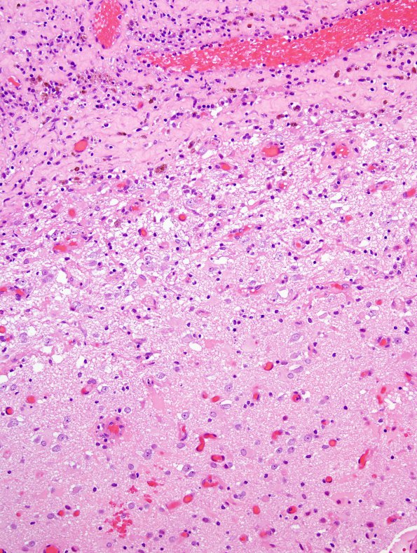 6B3 Abscess, acute & chronic (Case 6) H&E 9