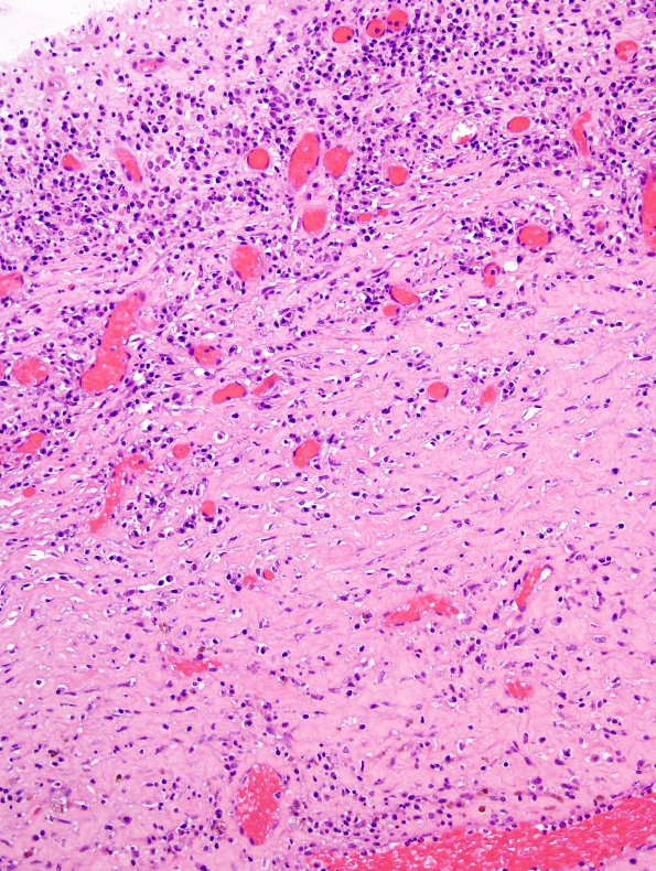 6B4 Abscess, acute & chronic (Case 6) H&E 10