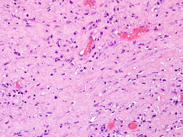 6B5 Abscess, acute & chronic (Case 6) H&E 12