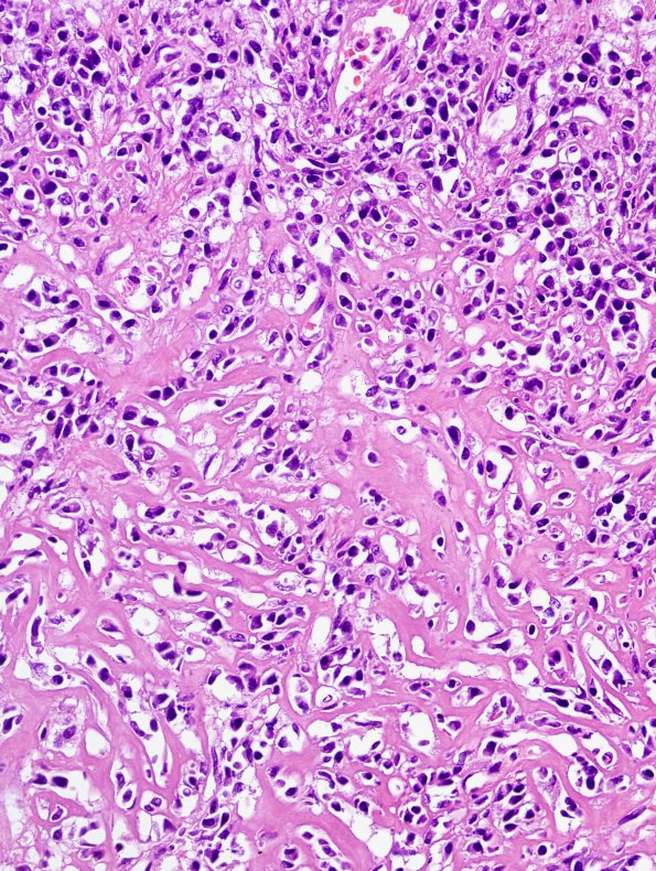 6B6 Abscess, acute & chronic (Case 6) H&E 4