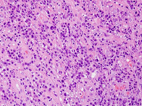 6B7 Abscess, acute & chronic (Case 6) H&E 14