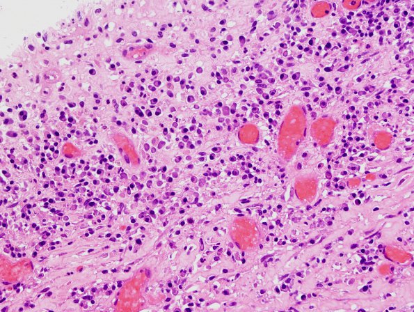 6B8 Abscess, acute & chronic (Case 6) H&E 11