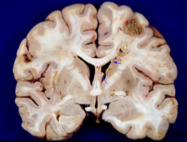 7A1 Abscesses, Daughter copy