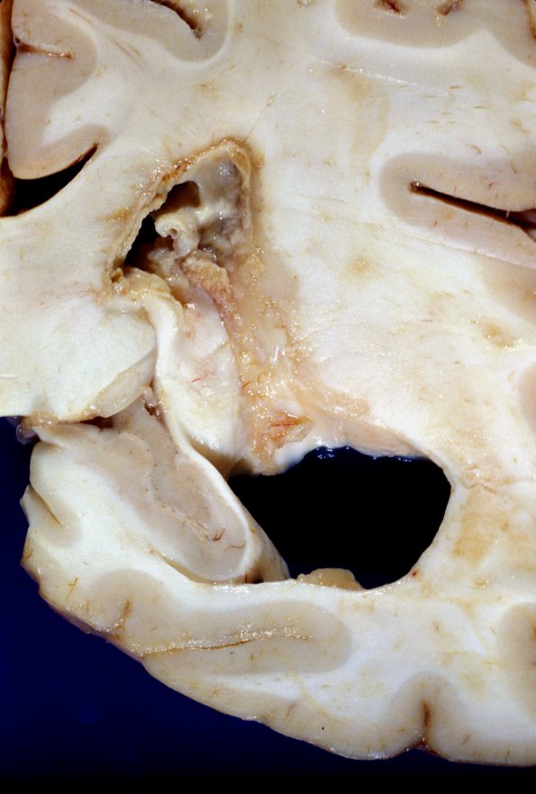 7A2 Abscess, ventricular extension