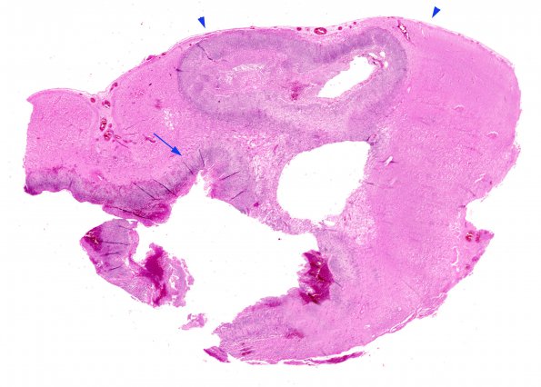 7B Abscess 2 copy