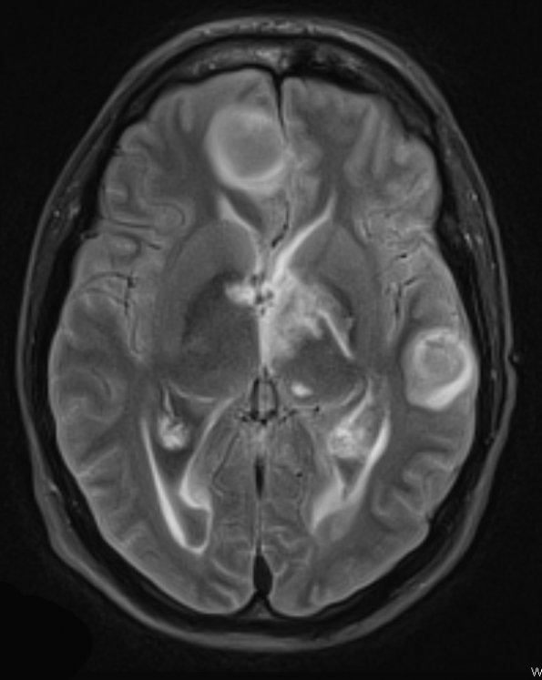 8A1 Abscesses, multiple (Case 8) TRA TIRM - Copy