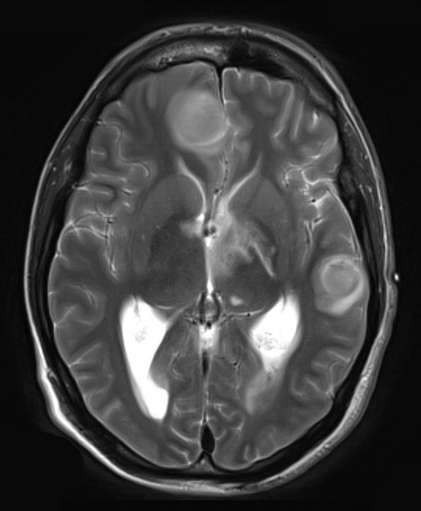 8A2 Abscesses, multiple (Case 8) T2 W - Copy