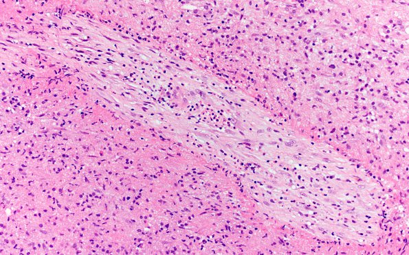 8B2 Abscesses, multiple (Case 8) H&E 1