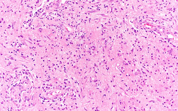 8B3 Abscesses, multiple (Case 8) H&E 2