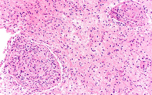 8B4 Abscesses, multiple (Case 8) H&E 3