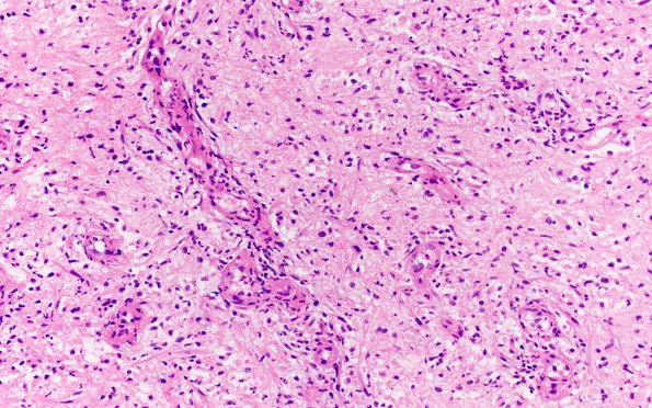 8B5 Abscesses, multiple (Case 8) H&E 4