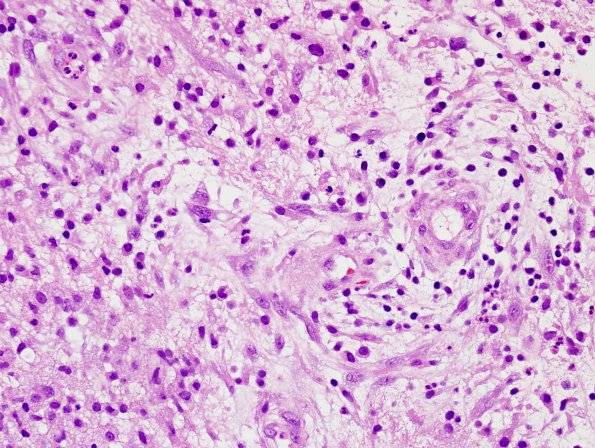 8B6 Abscess, Strep (Case 8) H&E 7