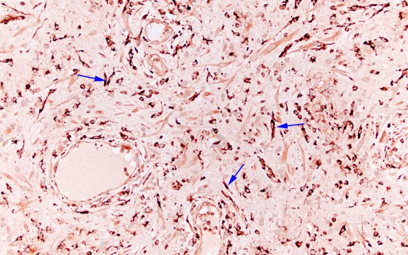 8C2 Abscesses, multiple (Case 8) CD68 20X 1 copy