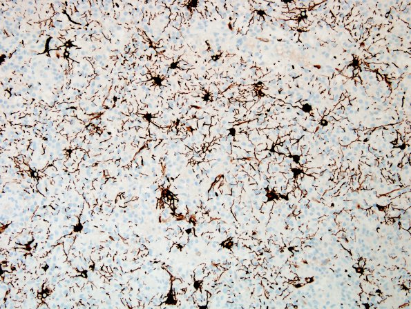 8C4 Abscess, Strep (Case 8) GFAP 3