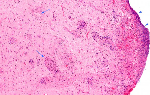 9A2 Abscess (Case 9) H&E 4 copy