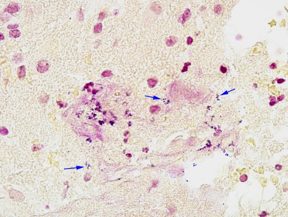 9B1 Abscess (Case 9) Gram 7 copy