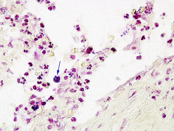 9B2 Abscess (Case 9) Gram 5 copy