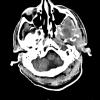 1A1 Subdural empyema (Case 1) CT 2 - Copy copy