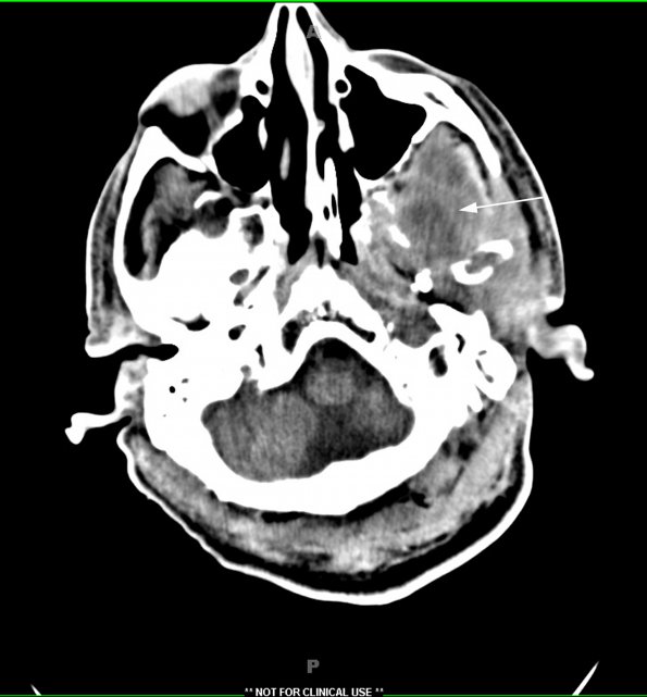 1A1 Subdural empyema (Case 1) CT 2 - Copy copy