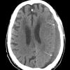 1A2 Subdural empyema (Case 1) CT 1 - Copy A