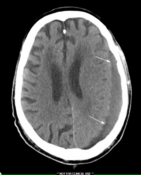 1A2 Subdural empyema (Case 1) CT 1 - Copy A