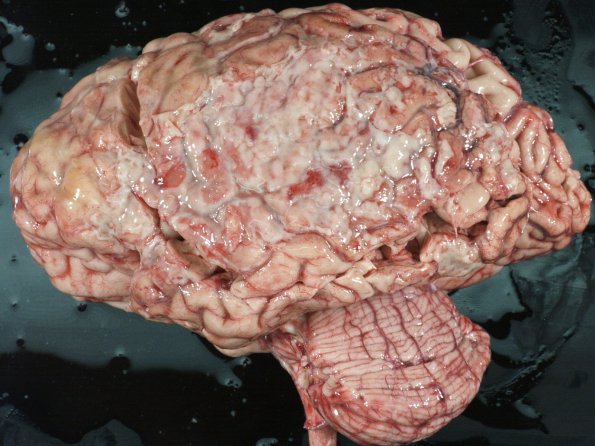 1B2 Empyema Subdural & Meningitis (Case 1) 5