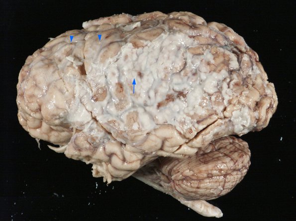 1B3 Empyema Subdural & Meningitis (Case 1) 6 copy