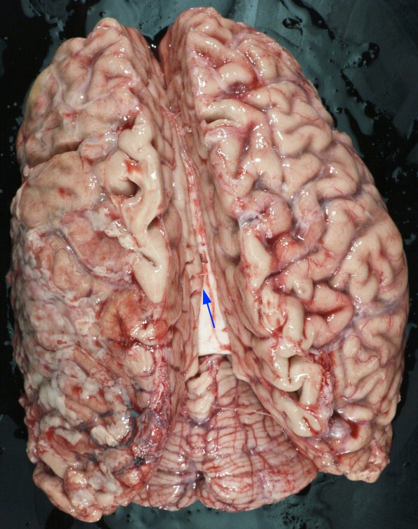 1B5 Empyema Subdural & Meningitis (Case 1) 4 copy