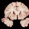 1B6 Empyema Subdural & Meningitis (Case 1) 12 copy