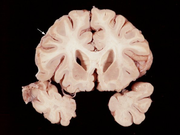 1B6 Empyema Subdural & Meningitis (Case 1) 12 copy