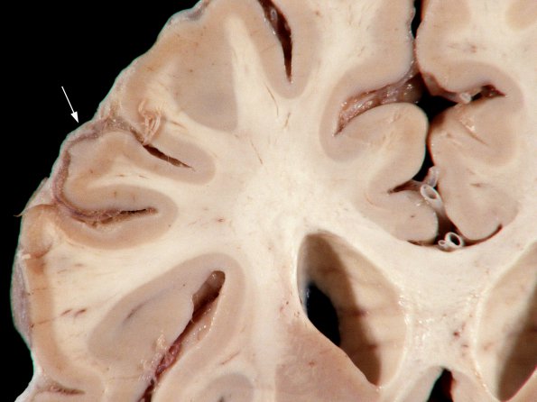 1B7 Empyema Subdural & Meningitis (Case 1) 13 copy