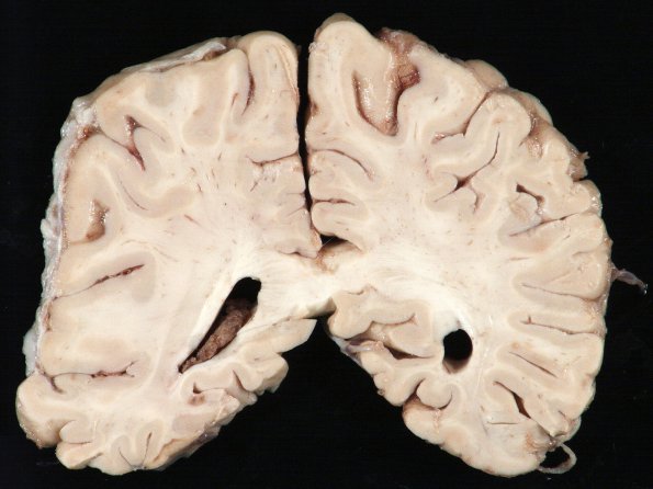 1B8 Empyema Subdural & Meningitis (Case 1) 10