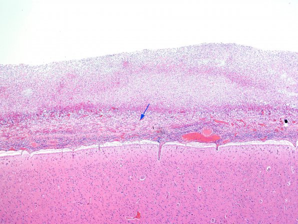 1C2 Empyema Subdural & Meningitis (Case 1) N26 H&E 2 copy