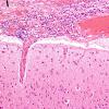 1C3 Empyema Subdural & Meningitis (Case 1) N26 H&E 1