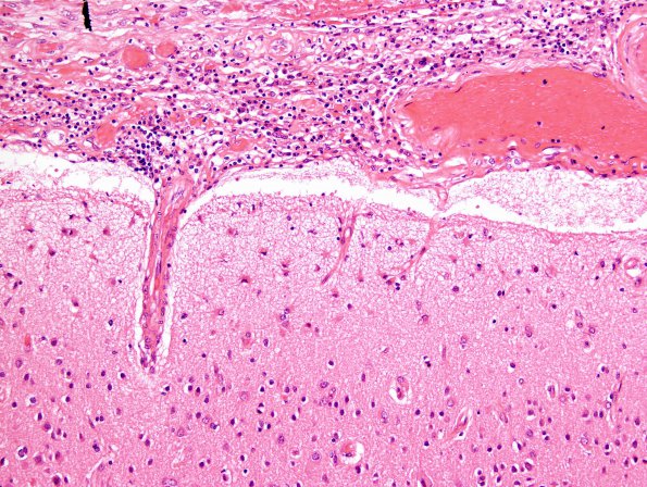 1C3 Empyema Subdural & Meningitis (Case 1) N26 H&E 1