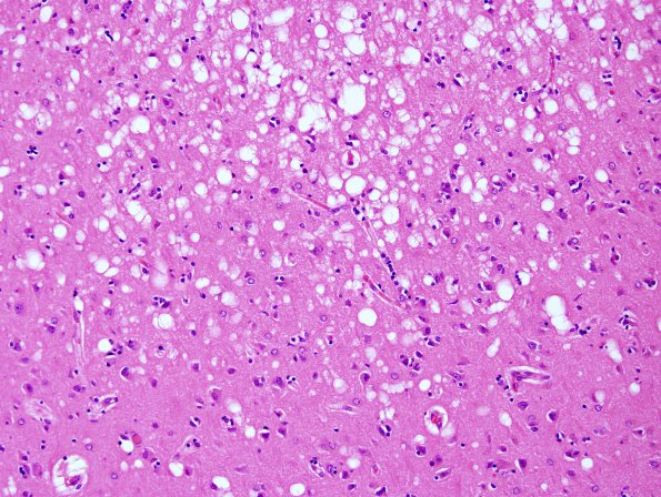 1C4 Empyema Subdural & Meningitis (Case 1) N26 H&E 3