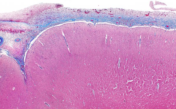 1D1 Empyema Subdural & Meningitis (Case 1) N26 Trichrome 2