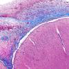 1D2 Empyema Subdural & Meningitis (Case 1) N26 Trichrome 1