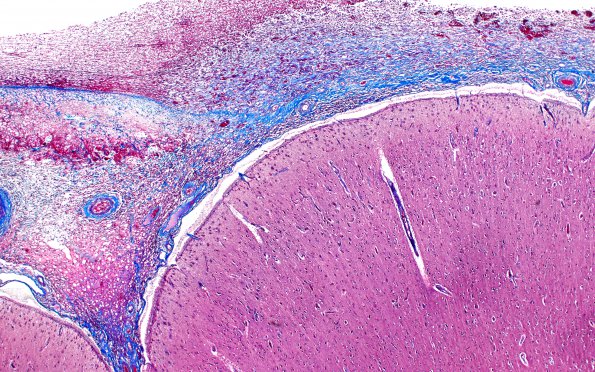 1D2 Empyema Subdural & Meningitis (Case 1) N26 Trichrome 1