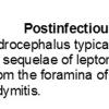 0A Postinfectious hydrocephalus - Text