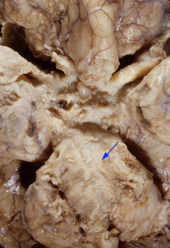 1A2 Meningitis, bacterial (Case 1) SAS involvement 2 copy