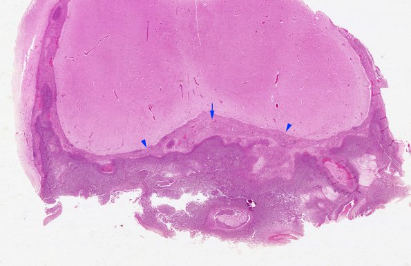 1B1 Meningitis, bacterial (Case 1) SAS involvement with hydrocephalus H&E whole mount 3 (2)