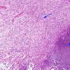 1B2 Meningitis & Abscess & Hydrocephalus (Case 1) N2 H&E 4 copy