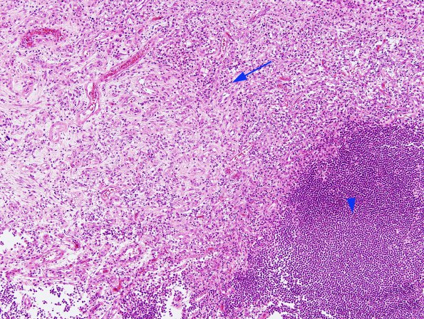 1B2 Meningitis & Abscess & Hydrocephalus (Case 1) N2 H&E 4 copy