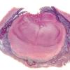 1C1 Meningitis, bacterial (Case 1) Trichrome 3