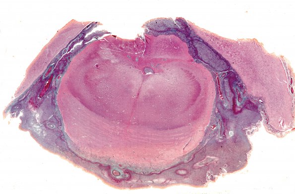 1C1 Meningitis, bacterial (Case 1) Trichrome 3