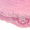 1C2 Meningitis, bacterial (Case 1) SAS involvement with hydrocephalus Trichrome 7 copy