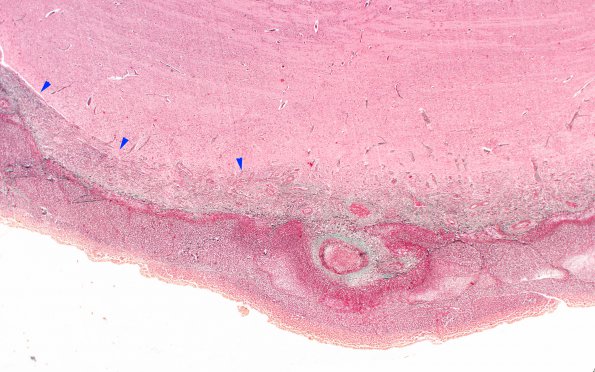 1C2 Meningitis, bacterial (Case 1) SAS involvement with hydrocephalus Trichrome 7 copy