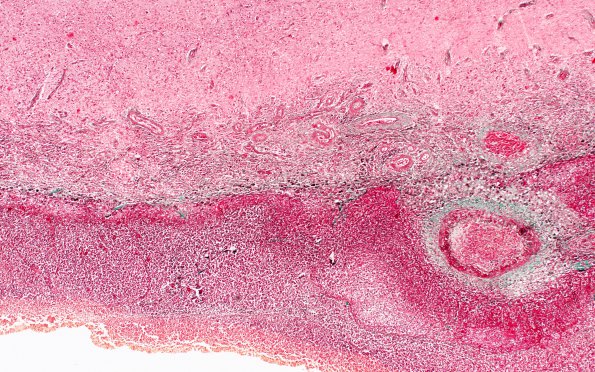 1C3 Meningitis, bacterial (Case 1) SAS involvement with hydrocephalus Trichrome 9